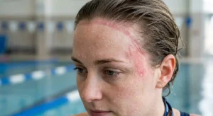 Rougeurs et irritation cutanée sur le front d'un nageur après port d'un bonnet en latex, signe d'allergie de contact